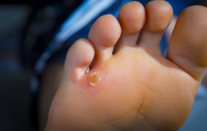 Differences Between Foot Corns and Calluses