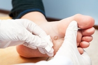 What Do Plantar Warts Look Like?