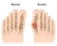 Simple Exercises That May Help Ease Bunion Discomfort