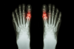 Managing Gout