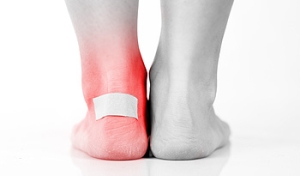 How Does a Blister Form?