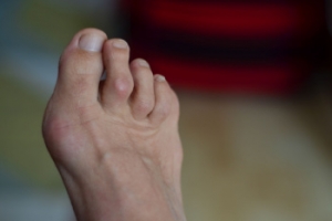 Insights Into Hammertoe