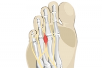 High Heels and Morton’s Neuroma