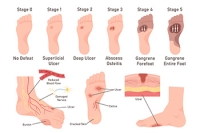 Causes and Care of Foot Ulcers