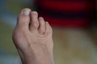 Hammertoe Fixes