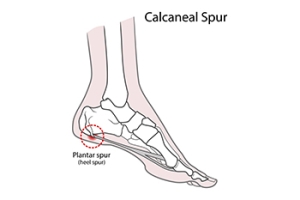 Types and Symptoms of Heel Spurs