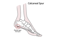Types and Symptoms of Heel Spurs