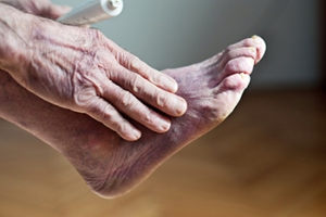 Systemic Sclerosis and Its Impact on Feet