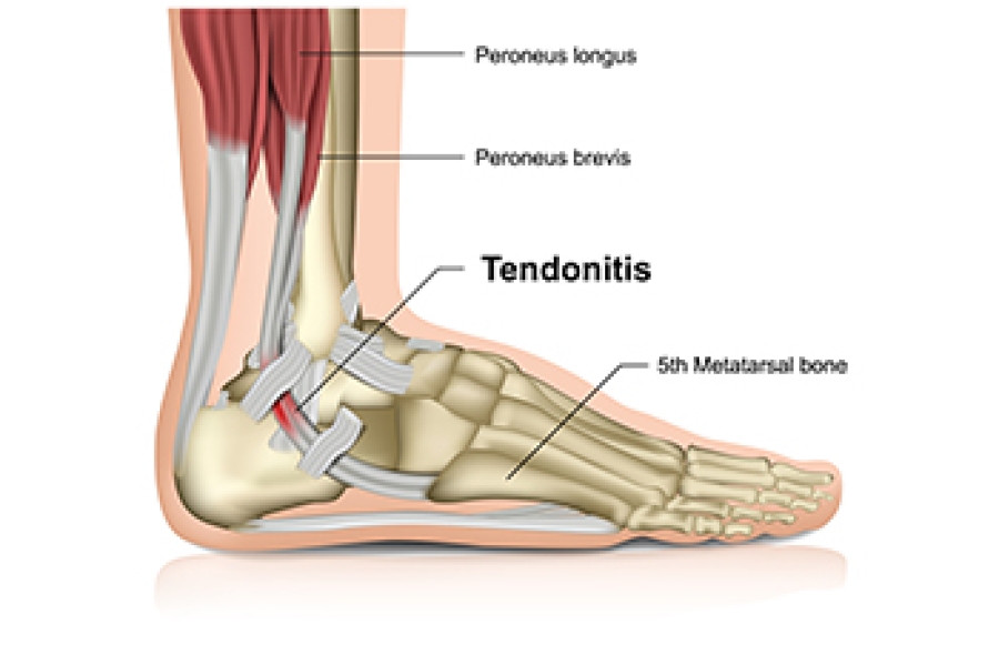 Diagram Pain Inner Side Of Heel Tendon Pain On The Side Of Heel