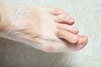Treatment of Hammertoe