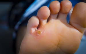Causes and Definition of Corns on the Feet