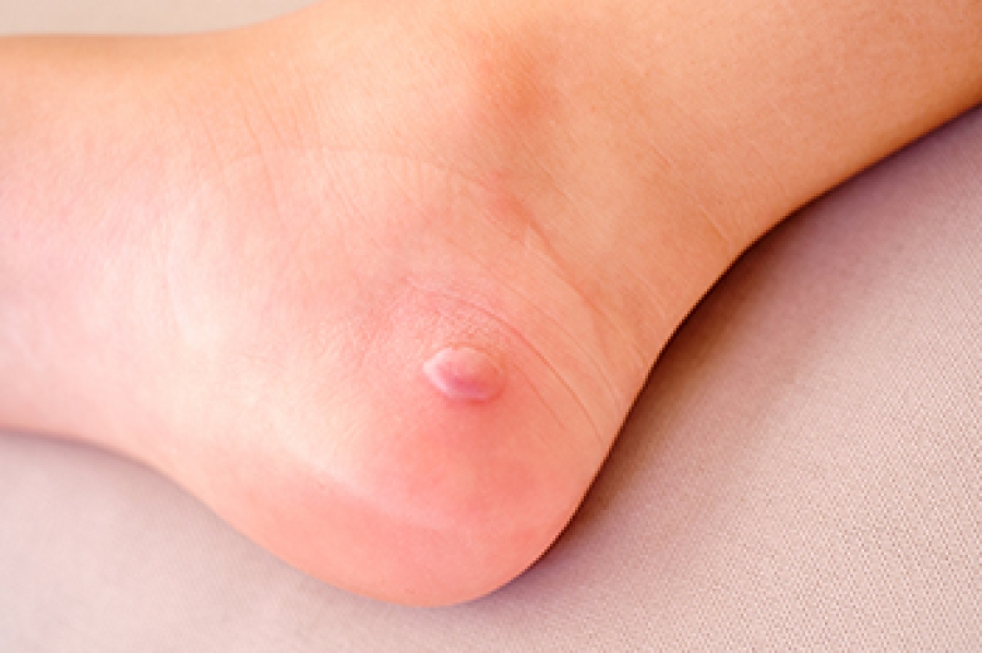 Signs and Causes of an Infected Foot Blister