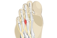 Complications of Morton’s Neuroma